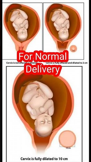 Open and Closed Cervix for Normal Delivery