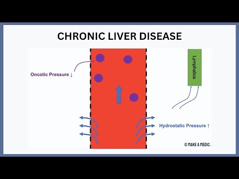 Chronic Liver Disease Explained