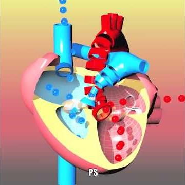 Congenital heart defects I: ASD, VSD, AS, PS, PDA and PFO
