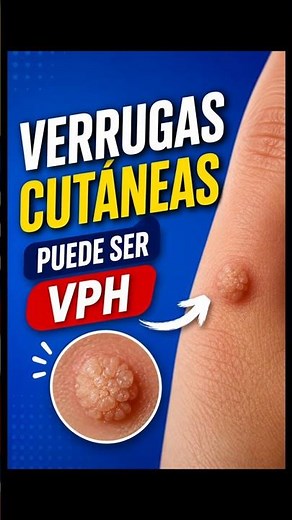 Do you have warts on your skin? They could be caused by the Human Papillomavirus (HPV).