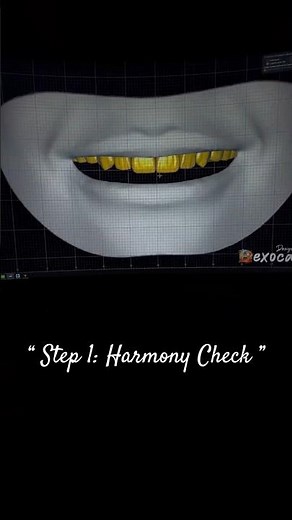 Smile Design Grid Preview – Digital Aesthetic Planning with CAD