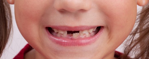 L'évolution de la dentition des enfants de 3 à 12 ans