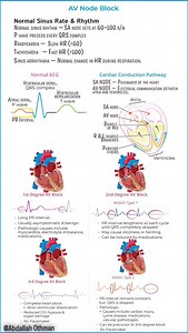 🎯📈Classification of AV Blocks: Save this guide 📌 | Share with your network! #Cardiology #ECG #HeartHealth #MedEd #AVBlocks | Abdallah Othman