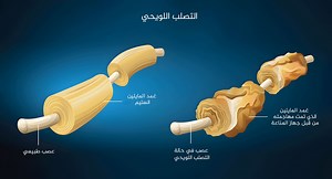 التصلب اللويحي.. الأعراض وكيفية حدوثه