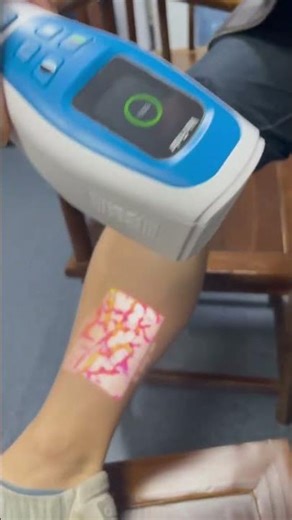 AI intelligent blood vessel detector #goodthing #factory #lab #machine #smartphone #nursingstudent