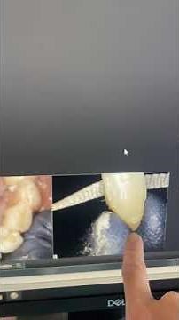 Failed Root Canal Infection Case & Fix