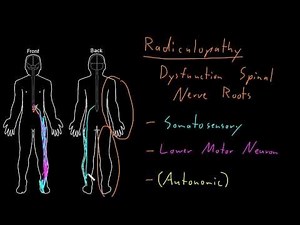 Syndrome: Radiculopathy