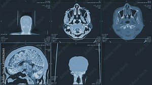 Magnetic resonance images of the brain, MRI of the brain, front and side view of a patient with multiple vascular infarctions, 3x3 image grid, color animation Seamless Loop