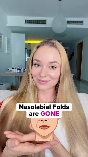 Effective Techniques to Reduce Nasolabial Folds