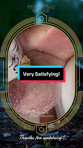 SqueezeUK popping acne pimple Satisfying abcess blackhead Removal viral #blackheads #pimplepop #skincare #acne #pimple @BlackheadsTV