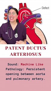 Auscultation Sounds: Understanding Patent Ductus Arteriosus