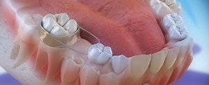 ▷ Mantenedor de espacio | ¿Qué son? - Clínica Dental Tacna