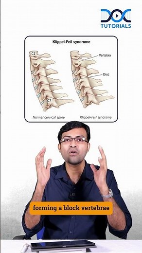 DocTutorials Daily Dose | Klippel Feil Syndrome The Hidden Triad | Dr Rohith Daniel - Orthopaedics