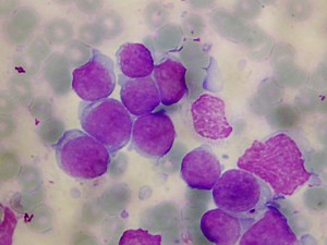 New T-Cell Leukemia Treatment Target Identified | Immunology