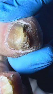 toenail removed successfully #nails #toenail #toenailremoval #ingrowntoenail #ingrownnail #toenailfungus #pedicure #onychomycosis Disclaimer: This video contains clips collected from various sources. Full credit goes to the original Chinese creators. This content is used for educational and monetization purposes only. All rights belong to their respective owners. | FC Studio