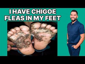 I Have a Flea Inside My Foot—Tungiasis Explained | Dr. David Campos
