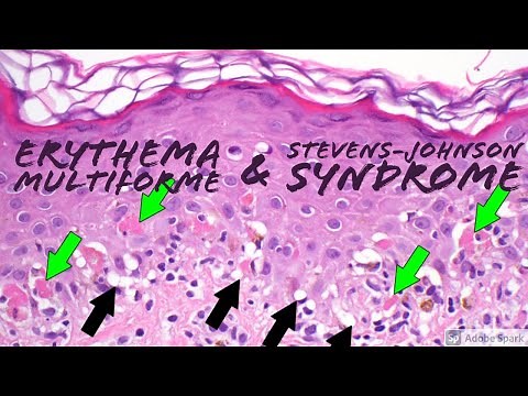 Stevens-Johnson Syndrome/Toxic Epidermal Necrolysis (SJS/TEN) & Erythema Multiforme Dermpath