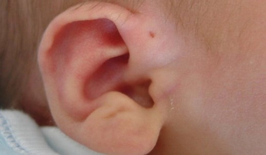 Hole in The Ear Spiritual Meaning: 9 Preauricular Pit Myths