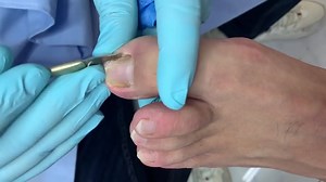39K views · 117 reactions | Lots of dead skin under nails and completely cleaned | Toenail +1 | Facebook