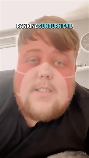 The important of sun protection #fail #sun #sunburn