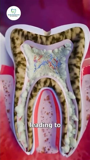 When a Cavity Turns Dangerous 🚨🦷