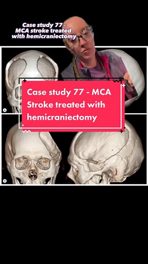 Case study 77 - MCA Stroke treated by hemicraniectomy * In 2021, 1 in 6 deaths from cardiovascular disease was due to stroke. * Every 40 seconds, someone in the United States has a stroke. Every 3 minutes and 14 seconds, someone dies of stroke. * Every year, more than 795,000 people in the United States have a stroke. About 610,000 of these are first or new strokes. * About 185,000 strokes—nearly 1 in 4—are in people who have had a previous stroke. * About 87% of all strokes are ischemic strokes