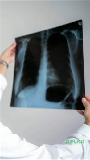 O que causa uma embolia pulmonar?