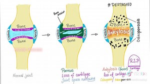 27 reactions | Definition and Pathophysiology of Rheumatoid Arthritis (RA). | Medicosis Perfectionalis | Facebook
