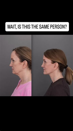 Lucas Bryant, MD on Instagram: "I couldn’t believe my eyes when I saw this patient today for follow up! She couldn’t stop smiling! Sometimes I have to double check what we did because incisions heal so well that it’s difficult to tell what happened, even for me! She underwent a #preservationdeepplanefacelift. Don’t you love the natural rejuvenating effect? Very happy for her. #preservationfacelift #faceliftbeforeandafter #deepplanefaceliftbeforeandafter #naturalfacelift #faceliftnashville"