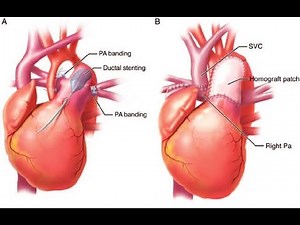 Pulmonary artery banding Surgery; reduce excessive blood flow to the lungs