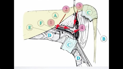 Arthrolyse PIP Joint | Hintringer Wolfgang | 10 comments