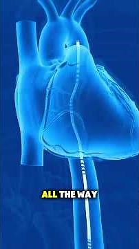 How Angioplasty Is Done | Step-by-Step Procedure Explained #Angioplasty #HeartBlockage