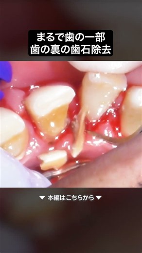 まるで歯の一部⁉️歯の裏の歯石除去🦷