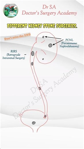 All Kidney Stone Surgeries | PCNL Vs RIRS Vs URSL Vs Cystolithotripsy |#Drsa |#Shorts