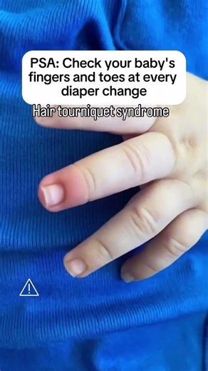 Hair Torniquet Syndrome #drleslietreece #pediatrician