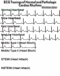 ✨ ECG Interpretation: Normal and Pathological Rhythms #ECG #EKG #Cardiology #MedEd #CardiacRhythms #HeartHealthRepost | Abdallah Othman