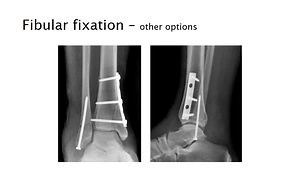 Lateral Malleolus Fractures