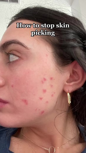 Understanding Dermatillomania: Causes, Treatment, and Tips to Stop Skin Picking