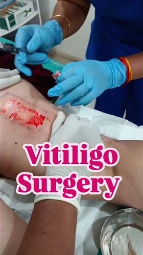 Vitiligo Surgery #vitíligo #vitiligopeople #whitepatches #skincare #shortvideo #shorts