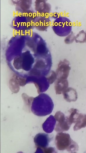 HLH hemophagocytic lymphohistiocytosis interesting hematology bone marrow findings,subscribe like