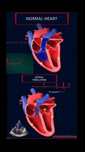 Atrial Fibrillation (AFib) vs. Normal Rhythm: A Visual Guide Normal Sinus Rhythm: ✅Synchronized electrical impulse. ✅Clear P-wave before each QRS complex. ✅Efficient pumping = optimal blood flow. Atrial Fibrillation: ❌Chaotic electrical activity in the atria. ❌Missing P-waves. Irregular baseline ("fibrillary waves"). ❌Irregularly irregular ventricular response. ❌Blood pools, increasing stroke risk by 5x. Recognize the rhythm. Prevent the stroke. #Electrophysiology #MedicalSchool #Cardiologist #A