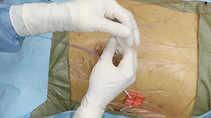 FiberTape® Sternal Closure for Rib Approximation After Thoracotomy Incisions