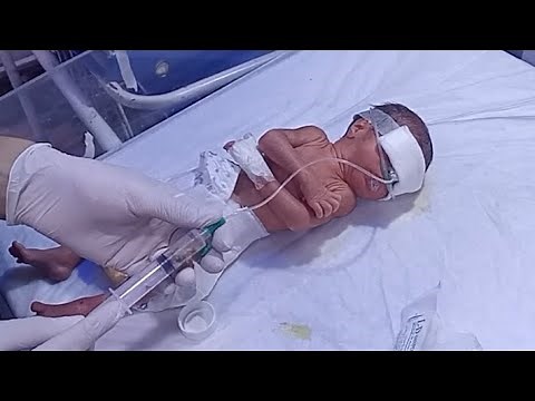How to Pass an NG Tube in a Newborn Baby | NICU Procedure Step-by-Step
