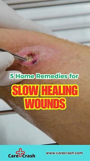 5 Natural Slow Healing Wounds Home Remedies | #carecrash