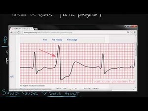 Electrocardiography: Cardiac Arrhythmias