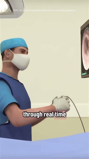 How Polypectomy Is Done (3D Animation) #polypectomy #colonoscopy #polypremoval #endoscopy