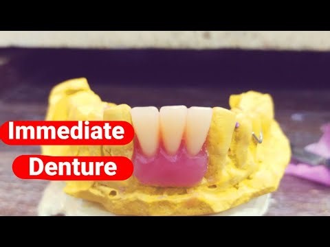 Temporary Removable Partial Denture ||Dental Art by Haider|| Immediate RPD by Haider||RPD Procedure.