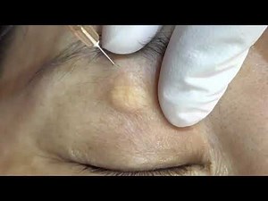 眼皮粉瘤/脂囊瘤切除 美麗新城診所莊禮謙醫師 steatocystoma/epidermal cyst, Dr George