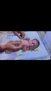 15K views · 350 reactions | NG_Tube_Insertion_in_a_Delayed_Cry_Baby___Neonatal_Care_Procedure__#nicu_#nicubabies #viral #trending #cutebaby #cannulation Anoop Gautam | Anoop Gautam | Facebook