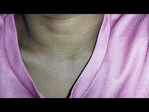 Respiratory distress with suprasternal and supra clavicular retractions